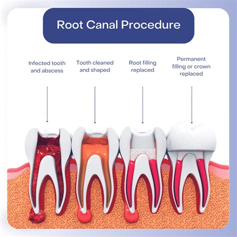 Problems With Root Canals