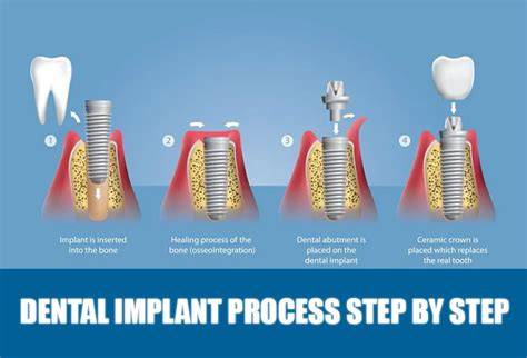 Process Of Dental Implants