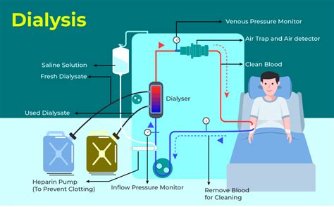 Process Of Kidney Dialysis