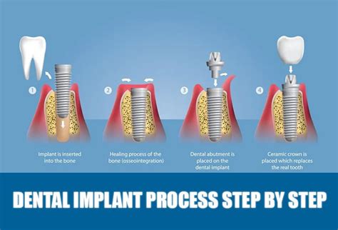 Process Of Tooth Implant