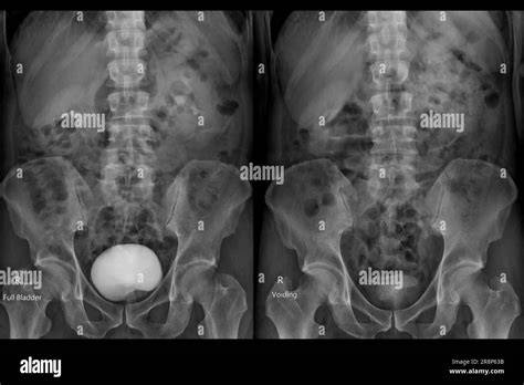 Process Of X Ray Filming The Bladder