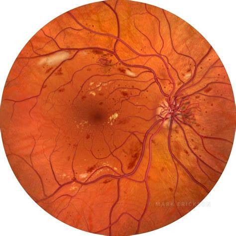 Proliferative Diabetic Retinopathy