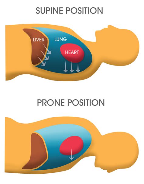 Prone Positioning