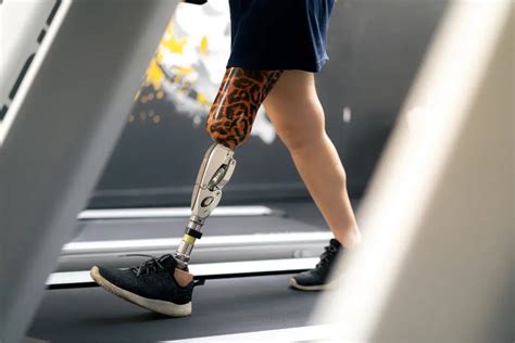 Prosthetic Leg Back To Normal
