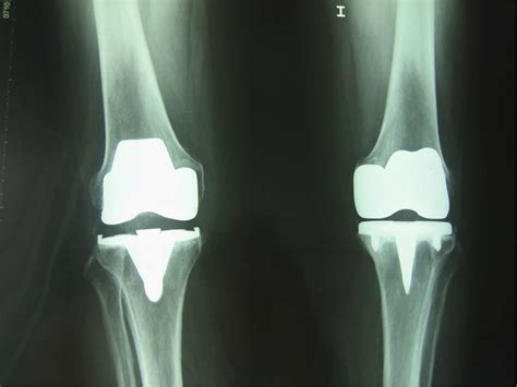 Protesis De Rodilla