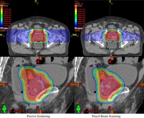 Proton Beam Prostate Cancer