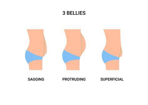 Protruding Belly Button