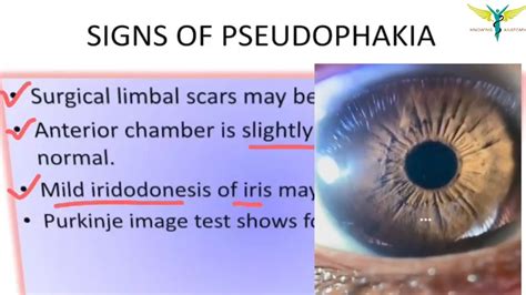 Pseudophakia Of Both Eyes