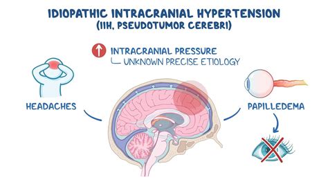 Pseudotumor Cerebri Treatment