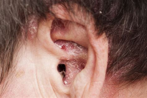 Psoriasis In Ears Canal
