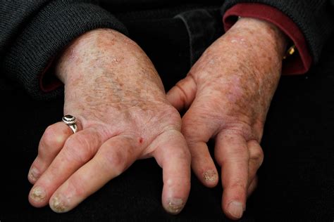 Psoriatic Arthritis Hands