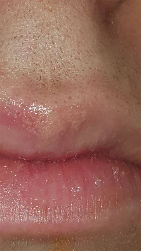 Puffy Bump On Lip