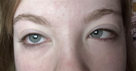 Puffy Swollen Eyes From Crying