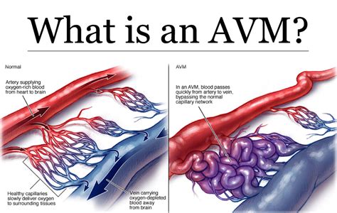 Pulmonary Arteriovenous Malformation
