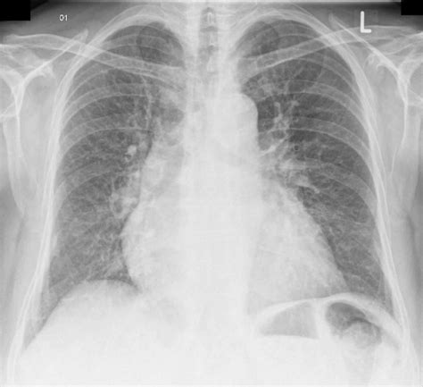Pulmonary Vascular Congestion