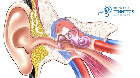 Pulsatile Tinnitus Treatment