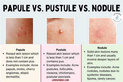 Pustule Vs Papule