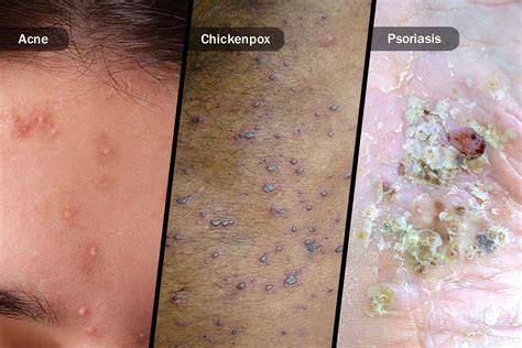 Pustules On Vag