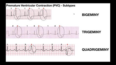 Pvcs And Pacs