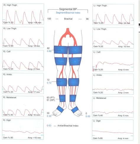 Pvr Medical Abbreviation