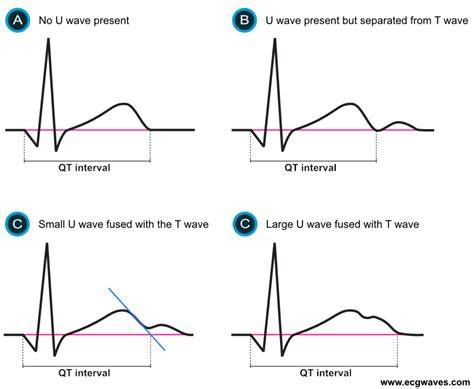 Qt Vs Qtc