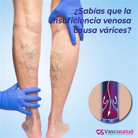 Que Es Insuficiencia Venosa