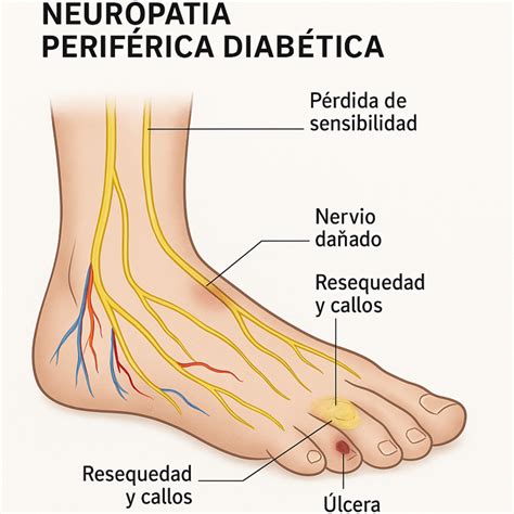 Que Es La Neuropatia