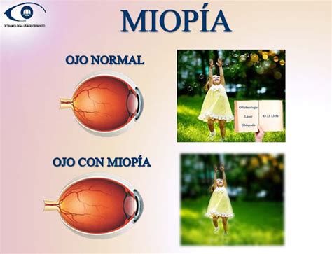 Que Es Miopia