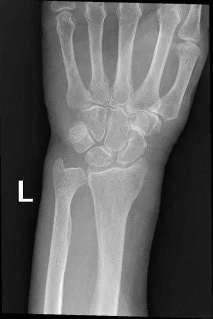 Radial Styloid Fracture