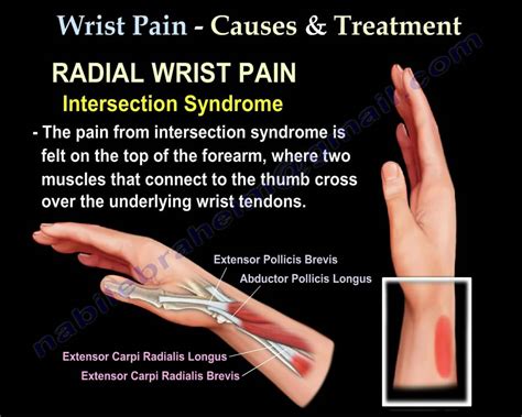 Radial Wrist Pain