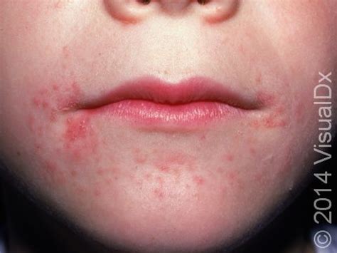Rash Around Child's Mouth