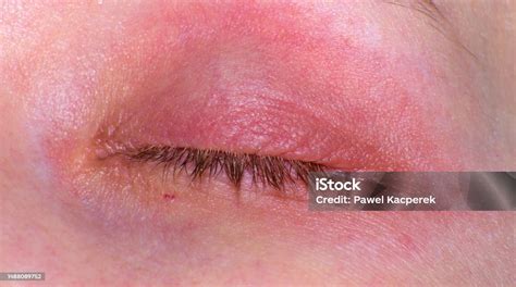 Rash On Eyelid