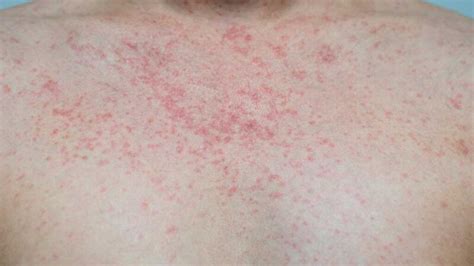 Rash Rsv Virus