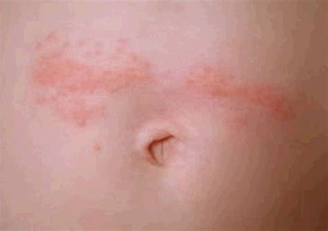 Rash Umbilical Area