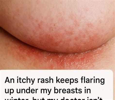 Rash Under Breasts
