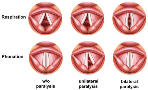 Raspy Voice Meaning
