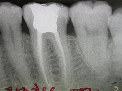 Rct Molar Teeth