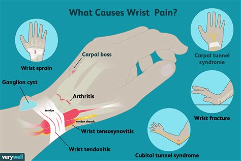 Reason Of Wrist Pain