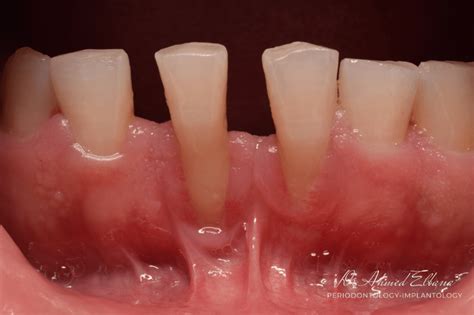 Recession Of Gingiva