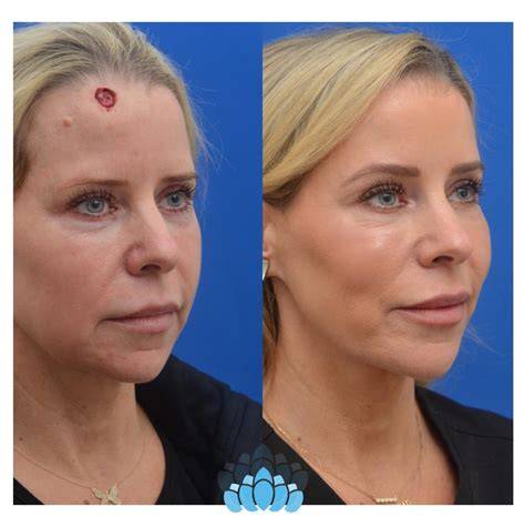 Recovering From Mohs Surgery On Face