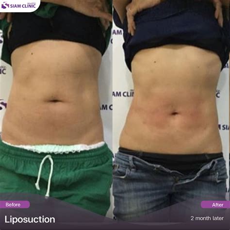 Recovery After Liposculpture