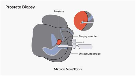 Recovery From Prostate Biopsy