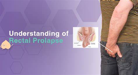 Rectal Prolapse Selfcare