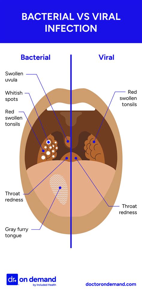Recurring Sore Throat