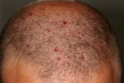 Red Dots On Scalp