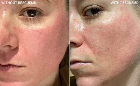 Red Face 24 Hours After Surgery