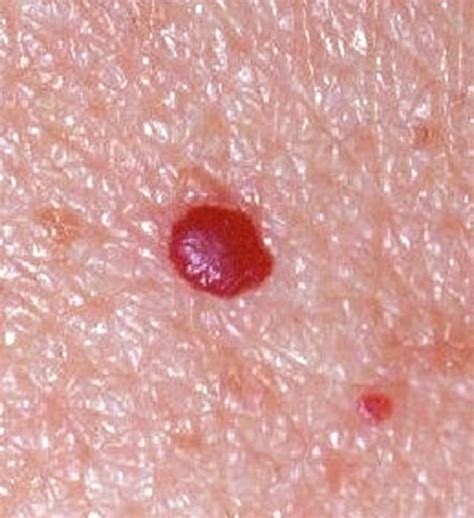Red Mole On Skin