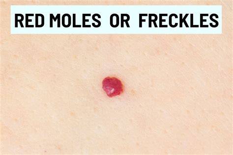 Red Moles On Skin