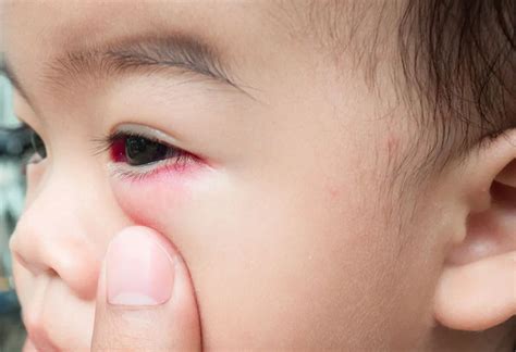 Redness On Eyelid Of Newborn