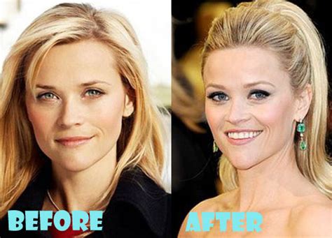Reese Witherspoon Face Surgery